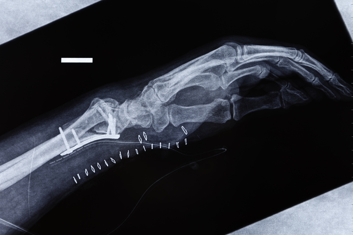 X-ray image wrist fracture